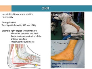 ORIF
Lateral decubitus / prone position
Fluoroscopy

Exsanguination
Tourniquet inflated to 350 mm of Hg

Extensile right-angled lateral incision
          Minimizes peroneal tendinitis
          Reduces devascularization of the
          anterior skin flap
          Preserves the sural nerve




                                                    Seligson's lateral extensile
                                                    approach
 