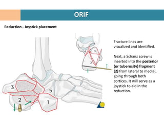 ORIF
Reduction - Joystick placement


                                        Fracture lines are
                                        visualized and identified.

                                        Next, a Schanz screw is
                                        inserted into the posterior
                                        (or tuberosity) fragment
                                        (2) from lateral to medial,
                                        going through both
                                        cortices. It will serve as a
                                        joystick to aid in the
                                        reduction.
 