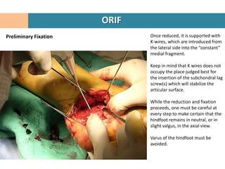 ORIF
Preliminary Fixation          Once reduced, it is supported with
                              K-wires, which are introduced from
                              the lateral side into the “constant”
                              medial fragment.

                              Keep in mind that K wires does not
                              occupy the place judged best for
                              the insertion of the subchondral lag
                              screw(s) which will stabilize the
                              articular surface.

                              While the reduction and fixation
                              proceeds, one must be careful at
                              every step to make certain that the
                              hindfoot remains in neutral, or in
                              slight valgus, in the axial view.

                              Varus of the hindfoot must be
                              avoided.
 