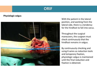 ORIF
Physiologic valgus
                            With the patient in the lateral
                            position, and working from the
                            lateral side, there is a tendency
                            for the hindfoot to fall into varus.

                            Throughout the surgical
                            maneuvers, the surgeon must
                            check continuously that the
                            hindfoot remains in valgus.

                            By continuously checking and
                            using K-wires as reduction tools
                            and temporary fixation,
                            physiologic valgus is maintained
                            until the final reduction and
                            fixation is obtained.
 
