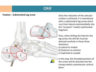 ORIF
Fixation – Subchondral Lag screw          Once the reduction of the articular
                                          surface is achieved, it is maintained
                                          with a subchondral lag screw which
                                          runs from lateral anteromedially into
                                          the “constant” medial subchondral
                                          fragment.

                                          Thus, when drilling the hole for the
                                          lag screw, the drill bit must be
                                          directed carefully in these three
                                          directions:
                                          a) Lateral to medial
                                          b) Posterior to anterior
                                          c) Cephalad to caudad

                                          In this way, the threaded portions of
                                          the screw will be directed into the
                                          strong medial sustentacular cortical
                                          bone.
 