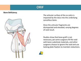 ORIF
Bone Deficiency
                     The articular surface of the os calcis is
                     impacted by the talus into the underlying
                     cancellous bone.

                     Once the articular fragments are
                     disimpacted and elevated, varying degrees
                     of void result.


                     Studies show that bone graft is not
                     necessary, yet some surgeons fill the void
                     with bone substitute materials, and other
                     surgeons choose to ignore the void and use
                     locking plate fixation to maintain reductions.
 