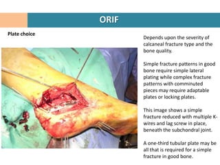 ORIF
Plate choice
                      Depends upon the severity of
                      calcaneal fracture type and the
                      bone quality.

                      Simple fracture patterns in good
                      bone require simple lateral
                      plating while complex fracture
                      patterns with comminuted
                      pieces may require adaptable
                      plates or locking plates.

                      This image shows a simple
                      fracture reduced with multiple K-
                      wires and lag screw in place,
                      beneath the subchondral joint.

                      A one-third tubular plate may be
                      all that is required for a simple
                      fracture in good bone.
 