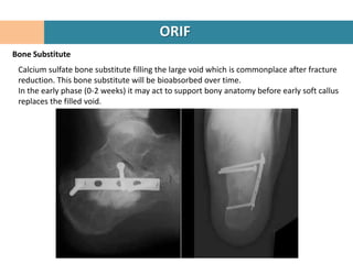 ORIF
Bone Substitute
 Calcium sulfate bone substitute filling the large void which is commonplace after fracture
 reduction. This bone substitute will be bioabsorbed over time.
 In the early phase (0-2 weeks) it may act to support bony anatomy before early soft callus
 replaces the filled void.
 