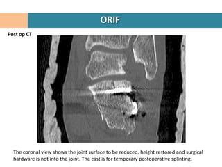 ORIF
Post op CT




  The coronal view shows the joint surface to be reduced, height restored and surgical
  hardware is not into the joint. The cast is for temporary postoperative splinting.
 