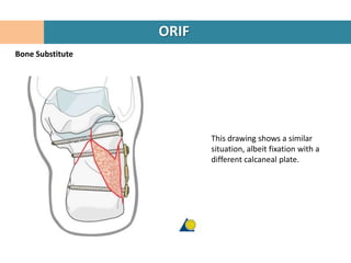 ORIF
Bone Substitute




                         This drawing shows a similar
                         situation, albeit fixation with a
                         different calcaneal plate.
 