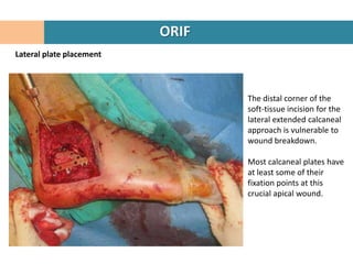 ORIF
Lateral plate placement




                                 The distal corner of the
                                 soft-tissue incision for the
                                 lateral extended calcaneal
                                 approach is vulnerable to
                                 wound breakdown.

                                 Most calcaneal plates have
                                 at least some of their
                                 fixation points at this
                                 crucial apical wound.
 