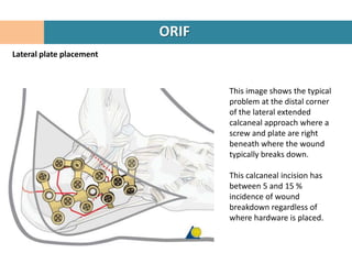 ORIF
Lateral plate placement



                                 This image shows the typical
                                 problem at the distal corner
                                 of the lateral extended
                                 calcaneal approach where a
                                 screw and plate are right
                                 beneath where the wound
                                 typically breaks down.

                                 This calcaneal incision has
                                 between 5 and 15 %
                                 incidence of wound
                                 breakdown regardless of
                                 where hardware is placed.
 