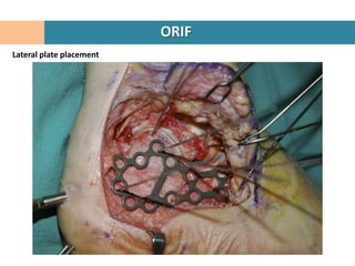 ORIF
Lateral plate placement
 