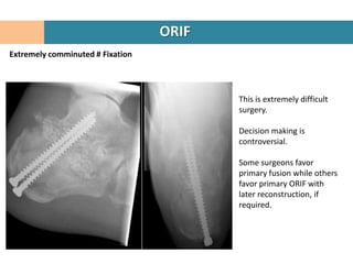 ORIF
Extremely comminuted # Fixation




                                         This is extremely difficult
                                         surgery.

                                         Decision making is
                                         controversial.

                                         Some surgeons favor
                                         primary fusion while others
                                         favor primary ORIF with
                                         later reconstruction, if
                                         required.
 