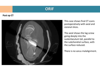 ORIF
Post op CT

                    This case shows final CT scans
                    postoperatively with axial and
                    coronal slices.

                    The axial shows the lag screw
                    going deeply into the
                    sustentaculum tali, parallel to
                    the subchondral surface, with
                    the surface reduced.

                    There is no varus malalignment.
 
