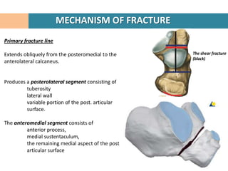 MECHANISM OF FRACTURE
Primary fracture line

Extends obliquely from the posteromedial to the    The shear fracture
                                                   (black)
anterolateral calcaneus.


Produces a posterolateral segment consisting of
         tuberosity
         lateral wall
         variable portion of the post. articular
         surface.

The anteromedial segment consists of
         anterior process,
         medial sustentaculum,
         the remaining medial aspect of the post
         articular surface
 