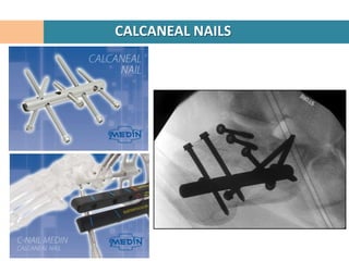 CALCANEAL NAILS
 