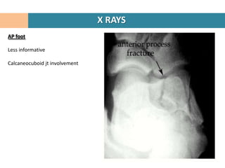 X RAYS
AP foot

Less informative

Calcaneocuboid jt involvement
 