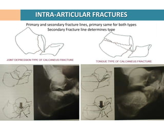 INTRA-ARTICULAR FRACTURES
Primary and secondary fracture lines, primary same for both types
            Secondary Fracture...