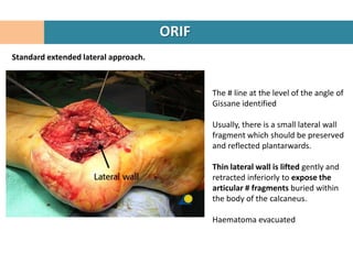 ORIF
Standard extended lateral approach.



                                             The # line at the level of the an...