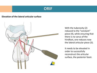 ORIF
Elevation of the lateral articular surface



                                                    With the tuberosity...