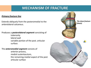 MECHANISM OF FRACTURE
Primary fracture line

Extends obliquely from the posteromedial to the    The shear fracture
       ...