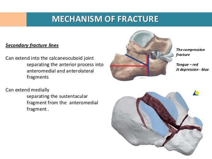 calcaneal fractures calcaneal fracture
