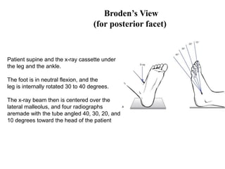 calcanealfractures-180405123703.pdf third year student | PDF