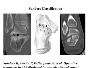 Sanders Classification Examples Calcaneal fractures | PPTX