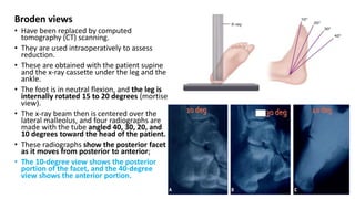 Calcaneal fractures | PDF