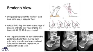Approach to and Management of calcaneal fractures.pptx