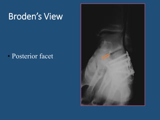 Calcaneal fractures --sito--29th aug 2015 | PPTX