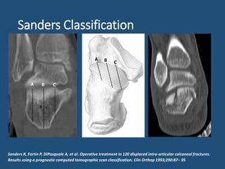 Sanders Classification Examples Calcaneal fractures --sito--29th aug 2015 | PPTX
