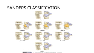 Sanders Classification Hand Descriptive calcaneal fracture presentation pptx.ppt