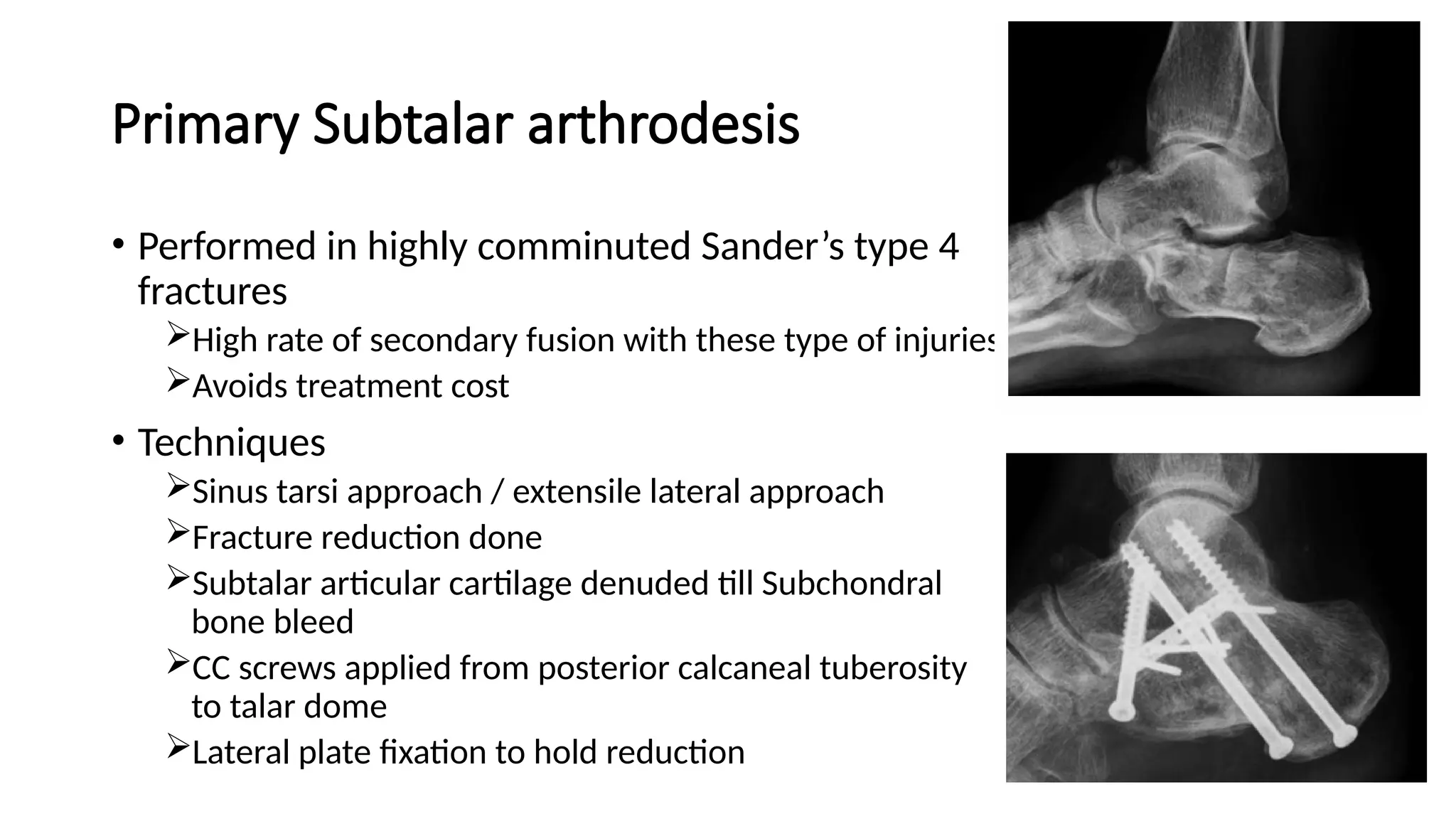 CALCANEAL FRACTURES PPT And JOURNAL pptx CALCANEAL FRACTURES PPT And JOURNAL pptx