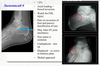 Sustentaculi #
● <2%
● Axial loading +
forced inversion
● Watch for FHL
injury
● Pain on inversion of
foot and passive
dorsiflexion of toes
● May Alter ST joint
mechanics
● Non union is
common
● Undisplaced – non
op
● Displaced – cc screw
or buttress plate
● Medial approach
 
