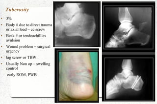 Tuberosity
● 3%
● Body # due to direct trauma
or axial load – cc screw
● Beak # or tendoachillies
avulsion
● Wound problem = surgical
urgency
● lag screw or TBW
● Usually Non op – swelling
control
early ROM, PWB
 