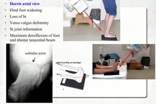 ● Harris axial view
● Hind foot widening
● Loss of ht
● Varus-valgus deformity
● St joint information
● Maximum dorsiflexion of foot
and plantar tangential beam
 