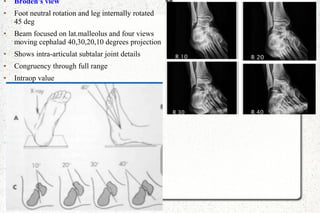 ● Broden's view
● Foot neutral rotation and leg internally rotated
45 deg
● Beam focused on lat.malleolus and four views
moving cephalad 40,30,20,10 degrees projection
● Shows intra-articulat subtalar joint details
● Congruency through full range
● Intraop value
 