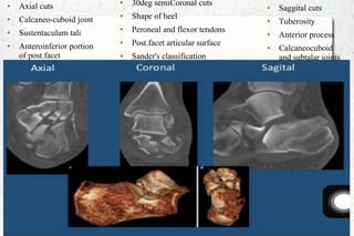 ● Axial cuts
● Calcaneo-cuboid joint
● Sustentaculum tali
● Anteroinferior portion
of post.facet
● 30deg semiCoronal cuts
● Shape of heel
● Peroneal and flexor tendons
● Post.facet articular surface
● Sander's classification
● Saggital cuts
● Tuberosity
● Anterior process
● Calcaneocuboid
and subtalar joints
 