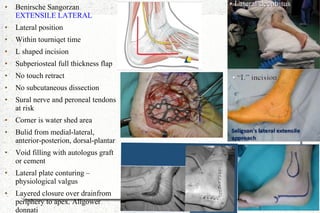 ● Benirsche Sangorzan
EXTENSILE LATERAL
● Lateral position
● Within tourniqet time
● L shaped incision
● Subperiosteal full thickness flap
● No touch retract
● No subcutaneous dissection
● Sural nerve and peroneal tendons
at risk
● Corner is water shed area
● Bulid from medial-lateral,
anterior-posterion, dorsal-plantar
● Void filling with autologus graft
or cement
● Lateral plate conturing –
physiological valgus
● Layered closure over drainfrom
periphery to apex. Allgower
donnati
 