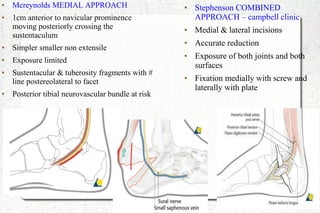 ● Mcreynolds MEDIAL APPROACH
● 1cm anterior to navicular prominence
moving posteriorly crossing the
sustentaculum
● Simpler smaller non extensile
● Exposure limited
● Sustentacular & tuberosity fragments with #
line postereolateral to facet
● Posterior tibial neurovascular bundle at risk
● Stephenson COMBINED
APPROACH – campbell clinic
● Medial & lateral incisions
● Accurate reduction
● Exposure of both joints and both
surfaces
● Fixation medially with screw and
laterally with plate
 