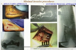 ● SINUS TARSI APPROACH ● ANTERIOR PROCESS APPROACH
Minimal invasive procedures
 