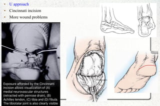 ● U approach
● Cincinnati incision
● More wound problems
 