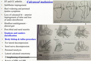 Calcaneal malunion● ST and CC arthritis
● Subfibular impingement
● Heel widening and peroneal
tendon symptoms
● Loss of calcaneal ht – anterior
impingement of talus and loss
of ankle dorsiflesion
● Hindfoot malalignment –
altered gait
● Post.tibial and sural neuritis
● Stephens and sanders
classification
● Braly bishop & tullos procedure
● For lateral decompression
● Sural nerve decompression
● Peroneal tenolysis
● Lateral calcaneal osteotomy
● Z-lengthening of peroneals
●
 