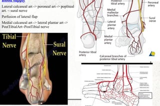 Blood supply
Lateral calcaneal art -> peroneal art -> popliteal
art. ~ sural nerve
Perfusion of lateral flap
Medial calcaneal art -> lateral plantar art ->
PostTibialArt~PostTibial nerve
 