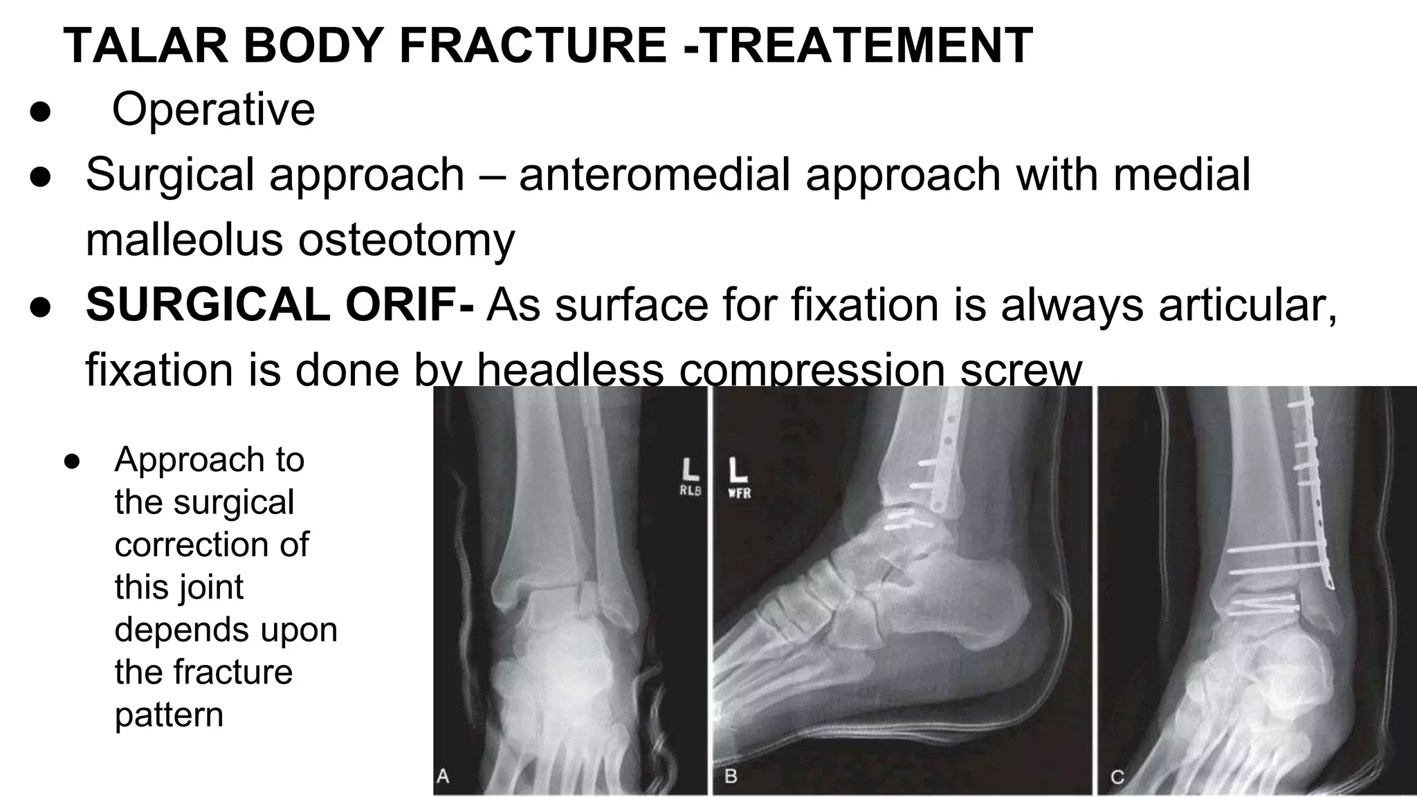FRACTURES of CALCANEUS AND TALUS | PPTX