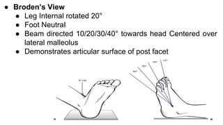 FRACTURES of CALCANEUS AND TALUS | PPTX