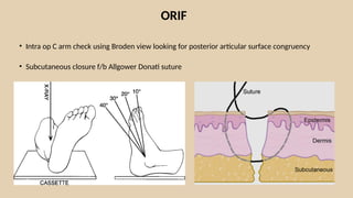 Comprehensive Management of Calcaneal and Talar Fractures in ...