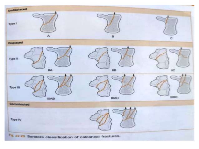 Rhowe Classification CALCANEUM FRACTURES.pptx
