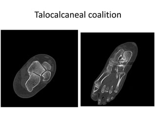 Talocalcaneal coalition
 