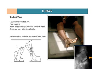 Calcaneum radiographic views