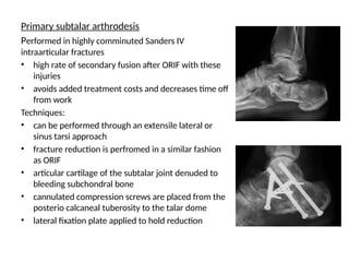 Calcaneus Fractures a brief presentation | PPTX