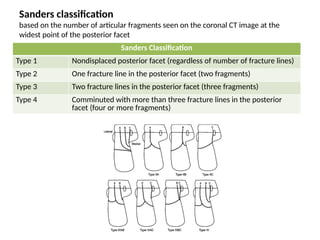 Sanders Classification Examples Calcaneus Fractures a brief presentation | PPTX